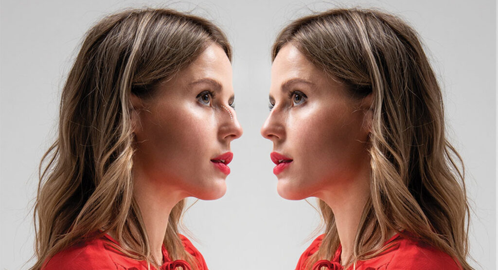 Non-surgical Rhinoplasty - Slightly crooked nose