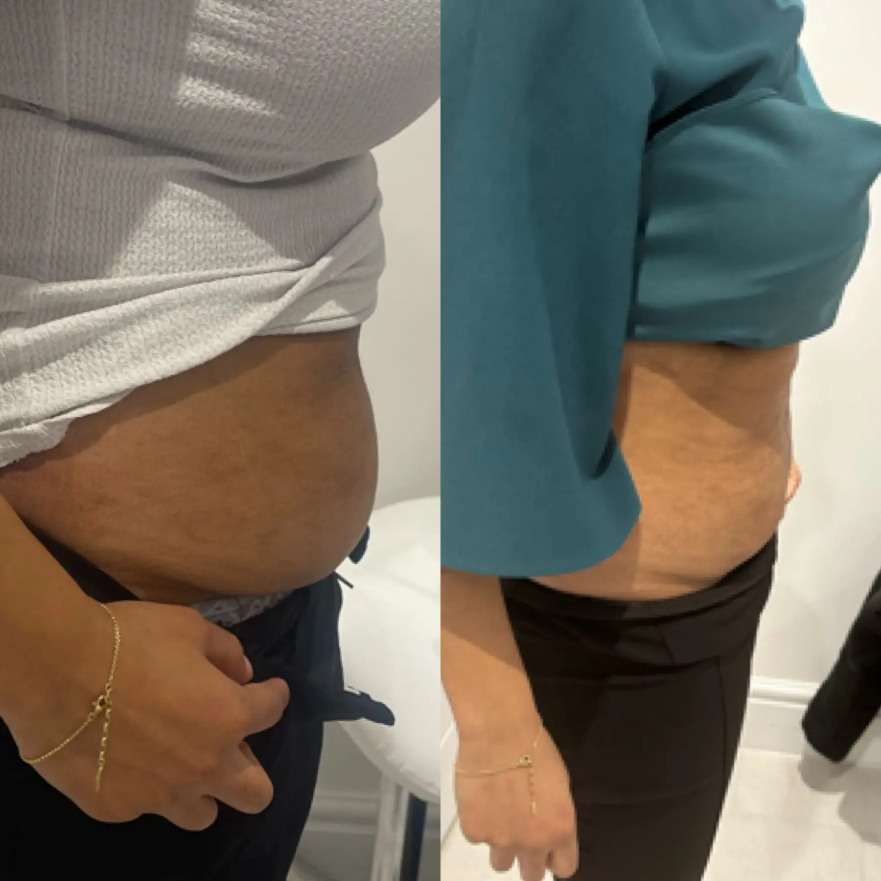 Radha’s Aqualyx Fat Dissolving Experience