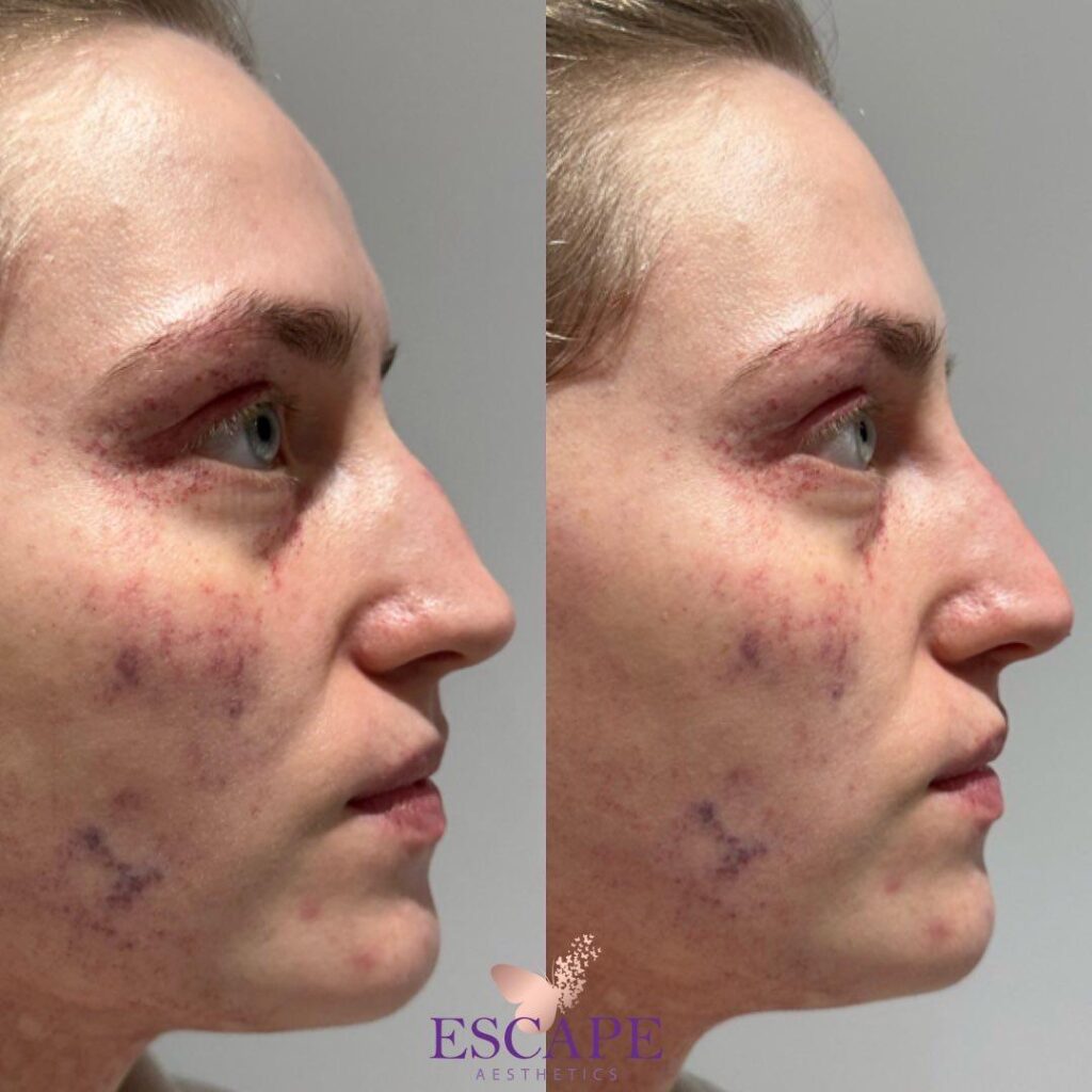 Non-surgical Rhinoplasty - Slightly crooked nose