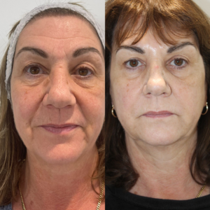 Dermal Filler at Escape Aesthetics