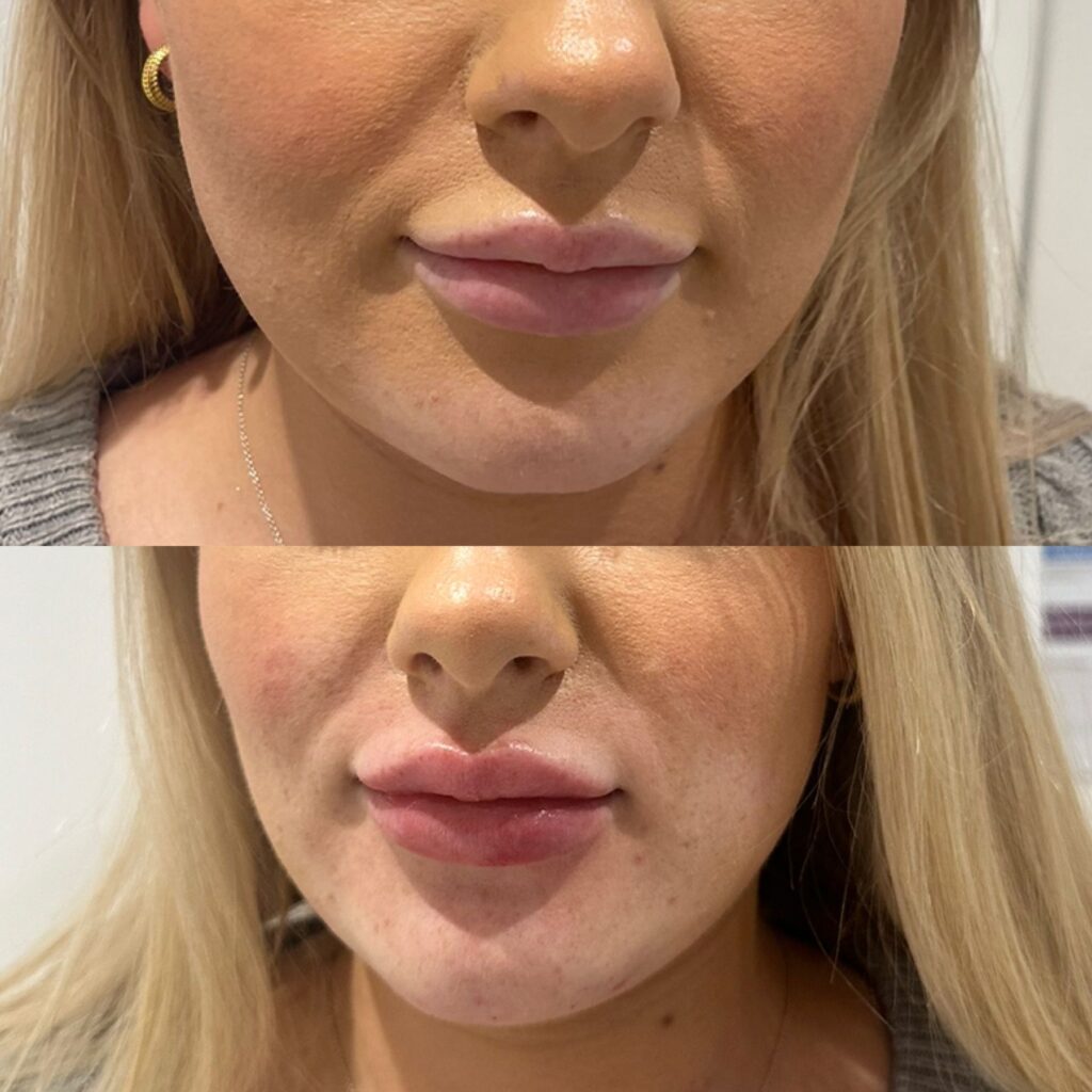 Chin Filler Escape Aesthetics