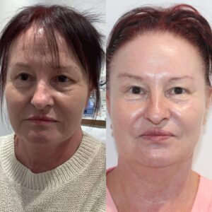 Dermal Filler at Escape Aesthetics