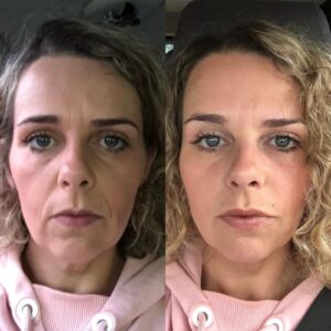 Dermal Filler at Escape Aesthetics