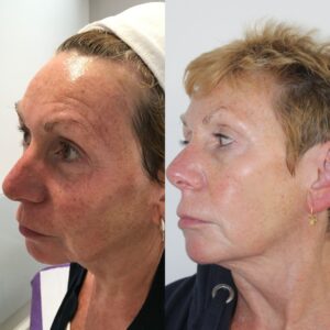 RF Needling at Escape Aesthetics