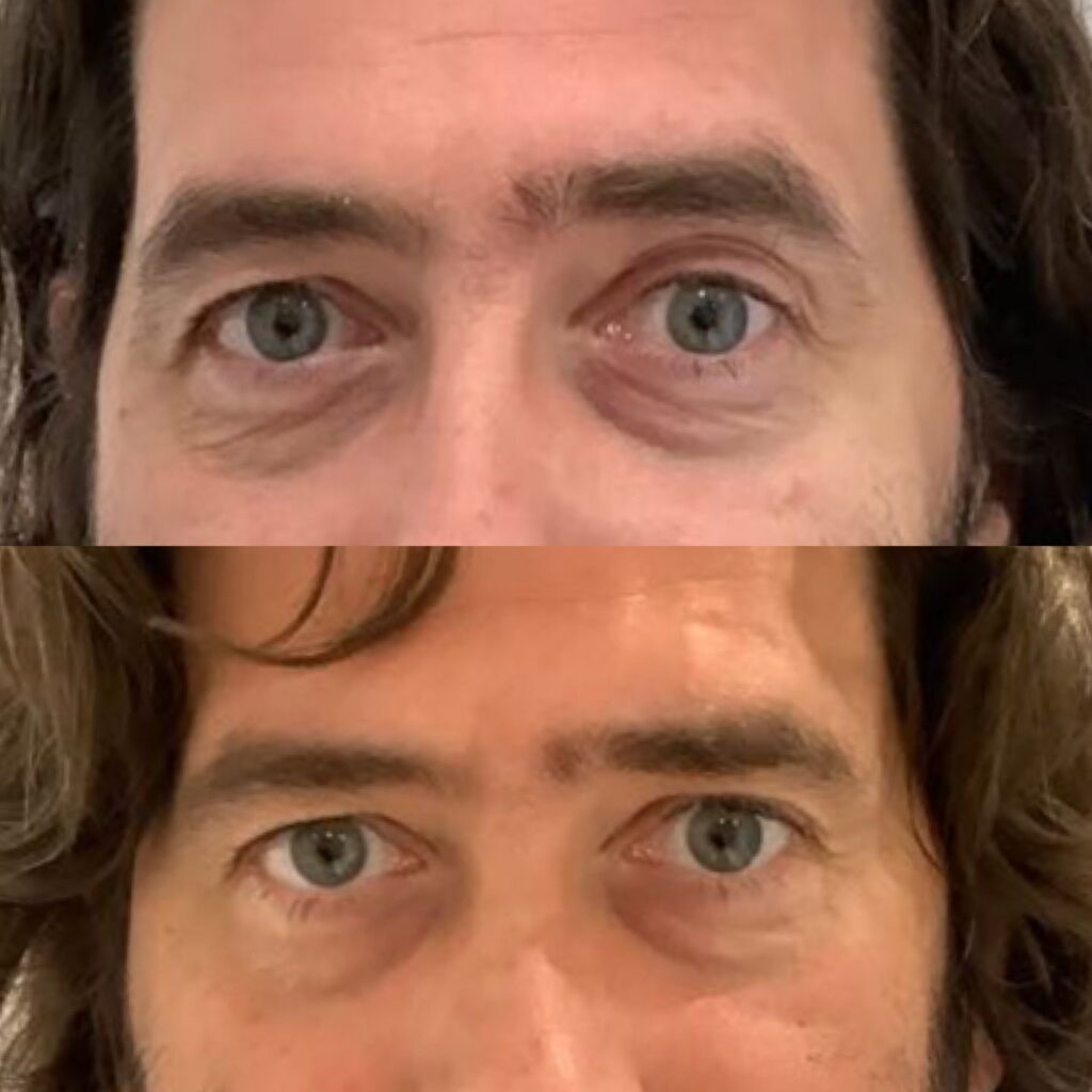 Before and after image of a man's eyes showing skin rejuvenation using polynucleotides.