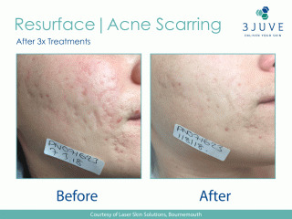 Before and after results of fractional laser resurfacing for acne scarring after three treatments at Escape Aesthetics.