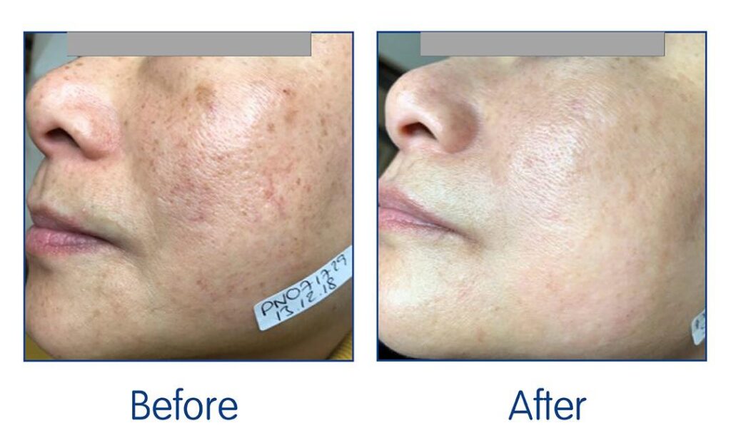 IllumiFacial before-and-after showing reduced pigmentation, brighter skin, and improved texture.