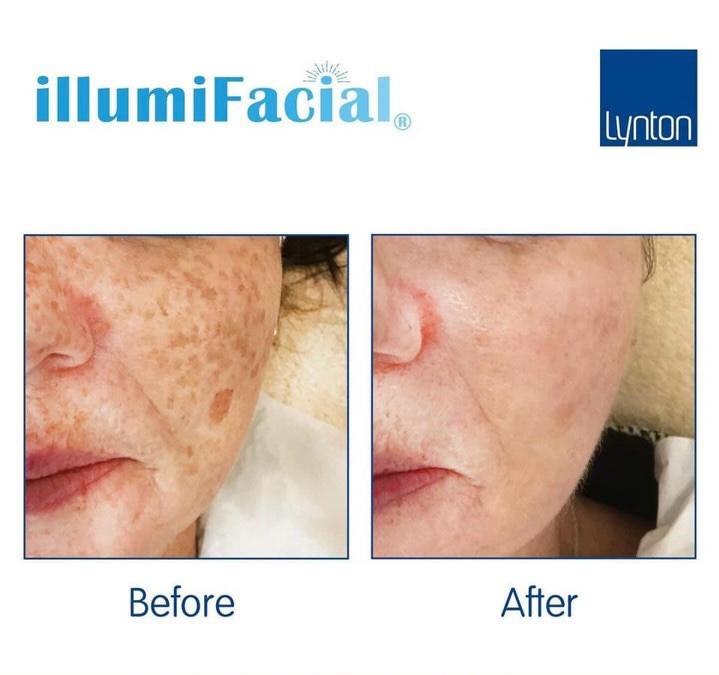 IllumiFacial treatment results—noticeable reduction in sun damage, pigmentation, and redness.