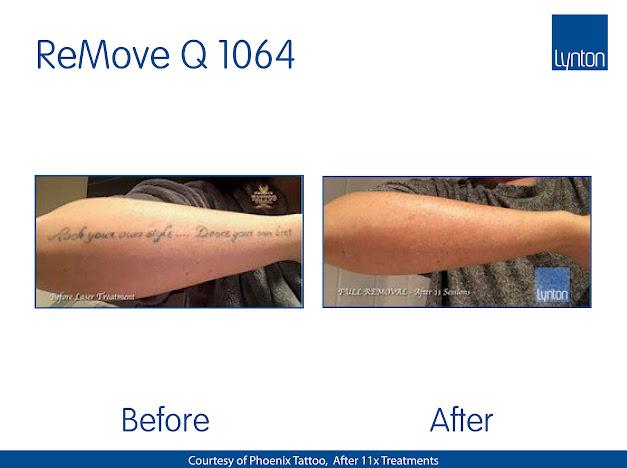 Before and after laser tattoo removal showing complete tattoo removal on the arm after 11 sessions.