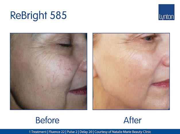 Before and after results of Lynton Laser thread vein removal treatment, showing clearer skin and reduced redness.